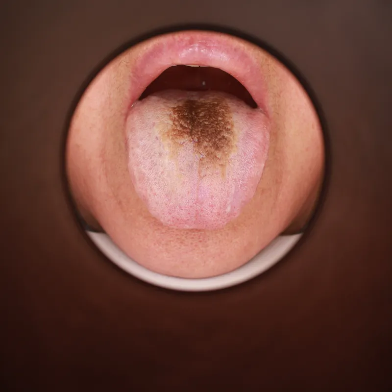 검게 변하는 혀 임상 사진