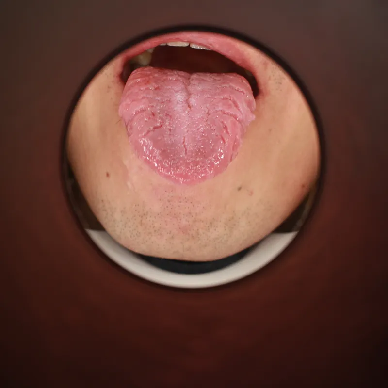 혀 갈라짐 임상 사진