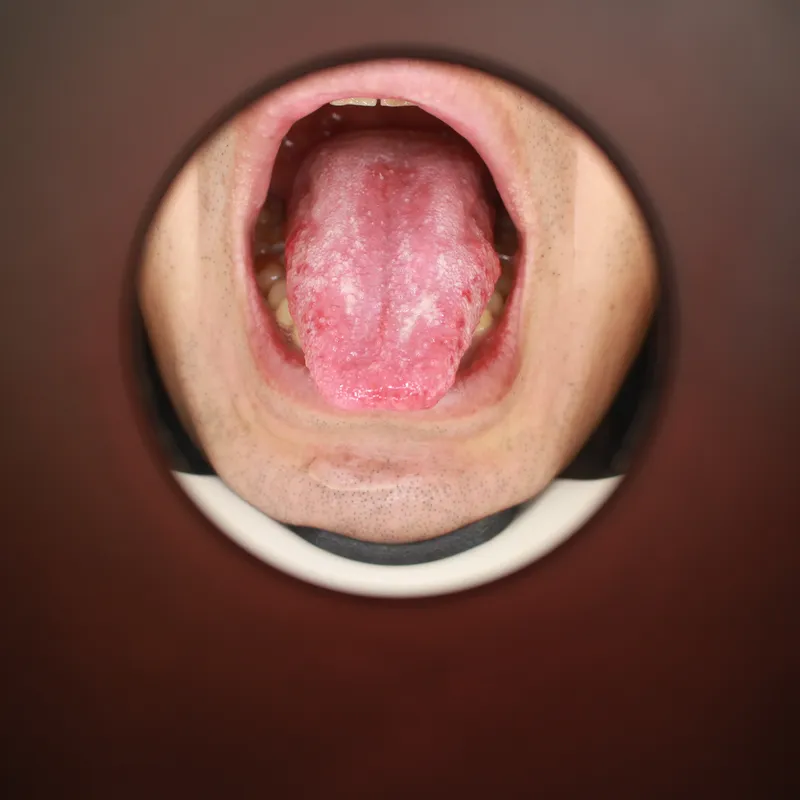 혀끝이 유난히 붉고 예민해진 상태